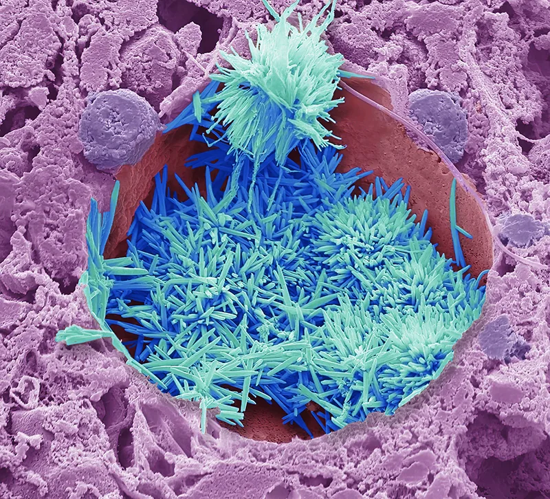 A microscopic image of cholesterol, in blue, in the liver. 