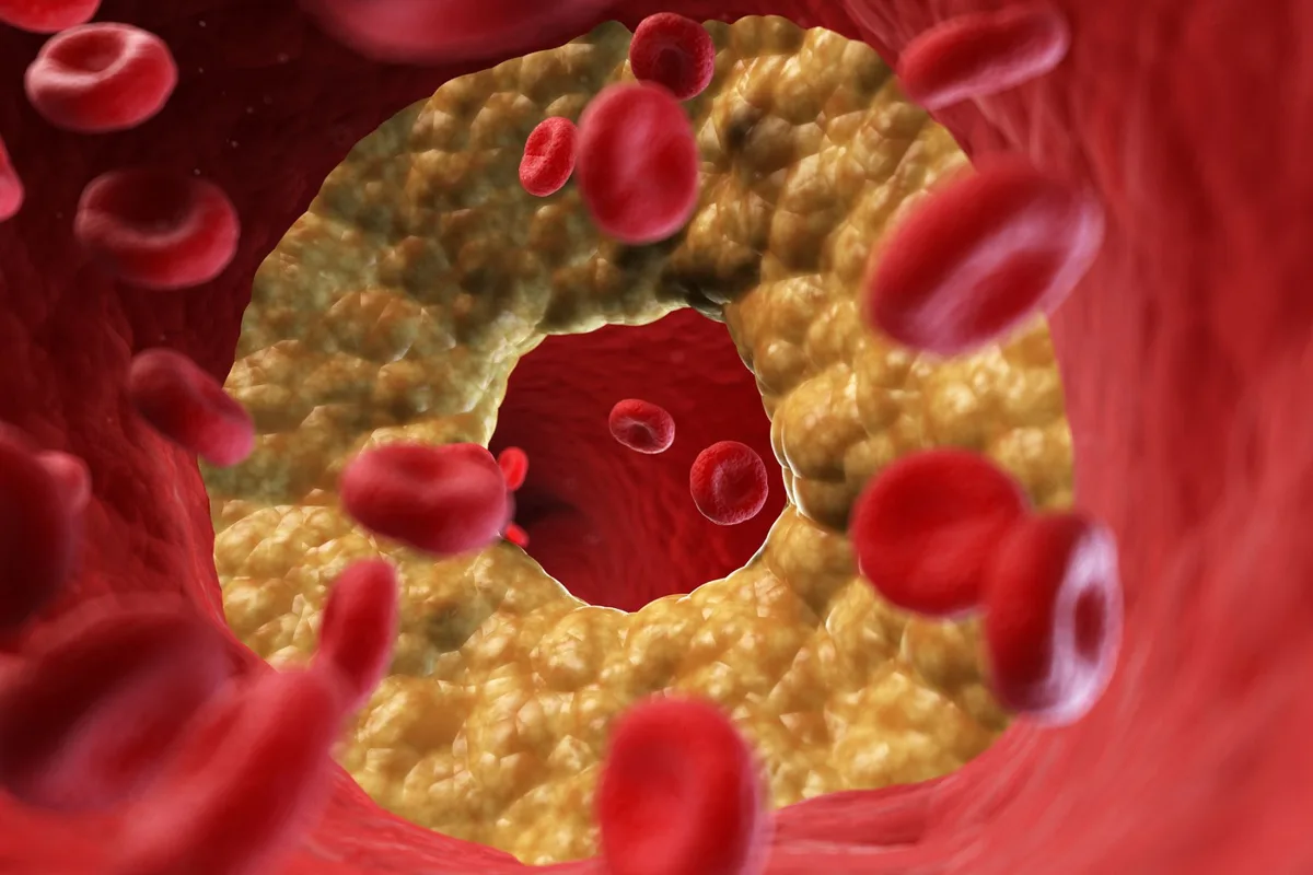 A computer generated illustration of red blood cells flowing through a blood vessel, with cholesterol plaque stuck to the lining